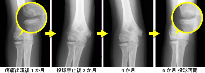 肘の骨軟骨炎は治るまでどのくらいかかりますか?