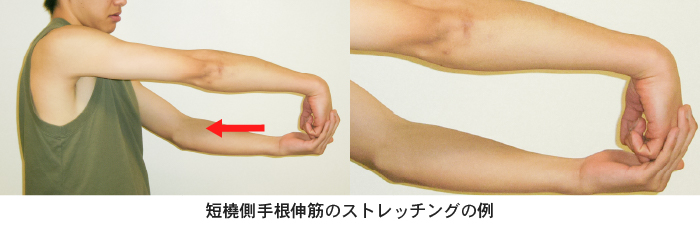 短橈側手根伸筋のストレッチングの例