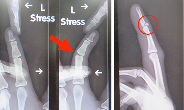 手指の骨折・靭帯損傷イメージ
