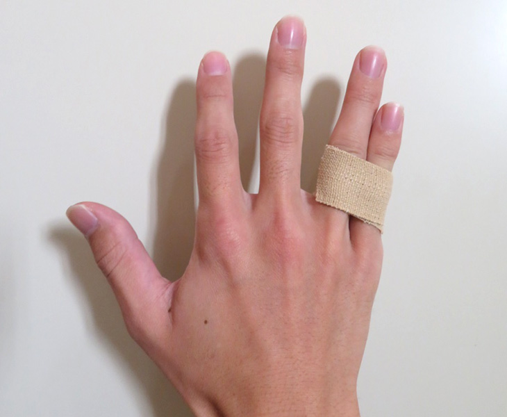 ずれの少ない安定している骨折に、隣の指とテーピングで治療している様子