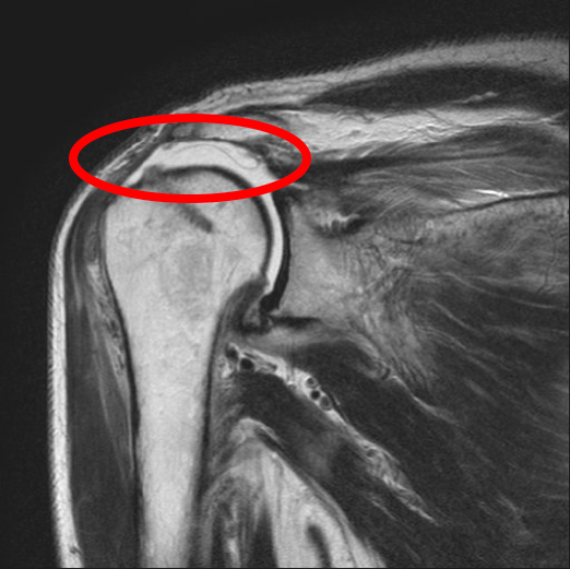 腱板断裂MRI例