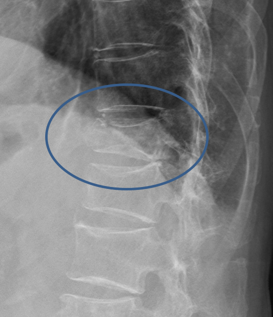 骨粗鬆症性脊椎圧迫骨折のレントゲン写真