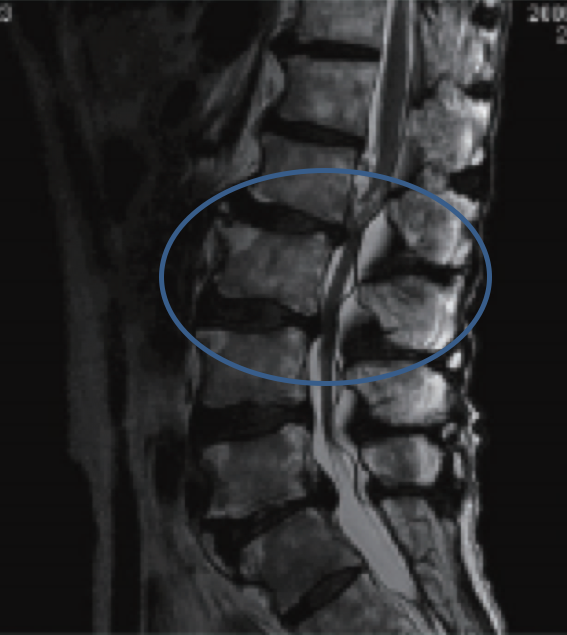 腰部脊柱管狭窄症のレントゲン写真